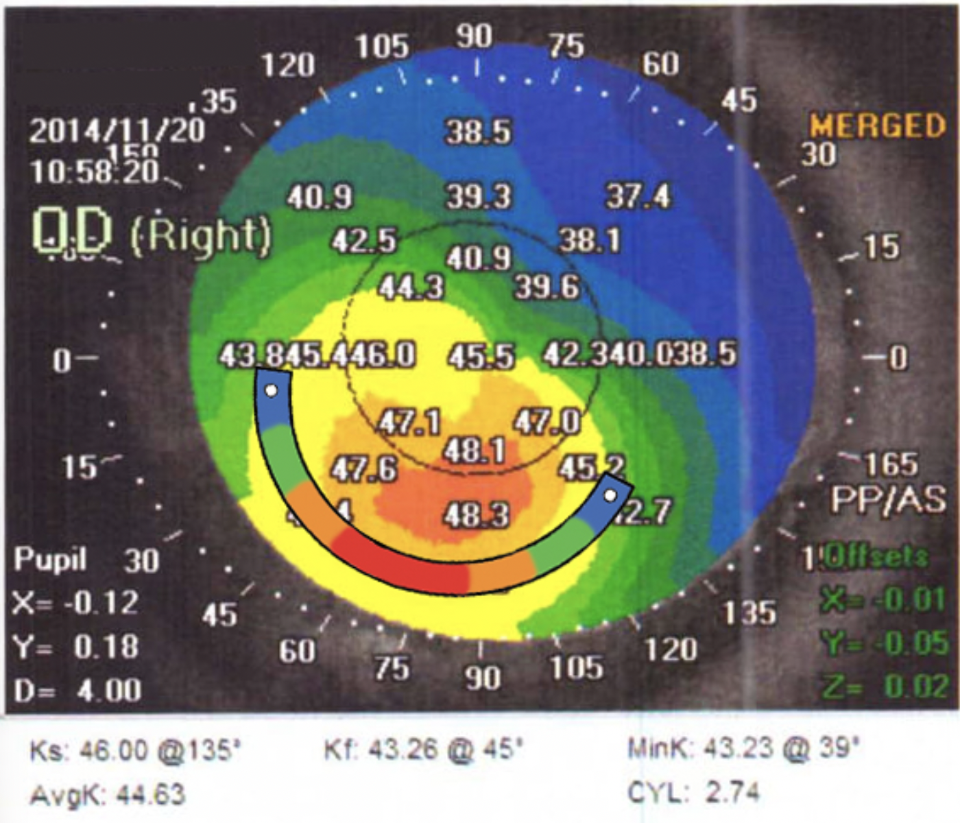 Barbara Ring corneal topography