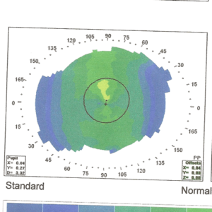 טופוגראפיה נורמאלית של הקרנית