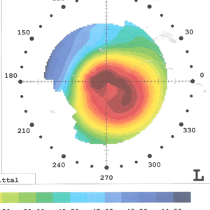 טופוגראפיה של קראטוקונוס