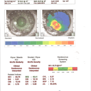 טופוגראפיה של קראטוקונוס