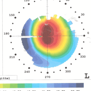 עין בה מושתלות טבעות Intacs SK