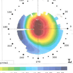 עין בה מושתלות טבעות Intacs SK