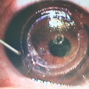 קרנית מייד אחרי סיום ניתוח השתלת טבעות Intacs בשיטה המכאנית