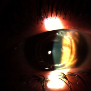 קרנית לאחר סיום ניתוח השתלת טבעות, הסרת האפיטל וזילוף טיפות ריבופלבין עד שהקרנית הפכה לצהובה עקב ספיגת הריבופלבין