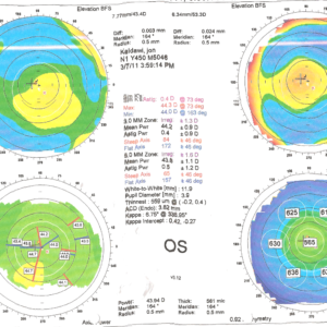 Orbscan נורמאלי
