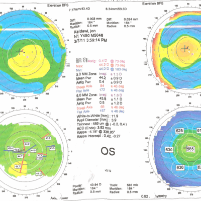 Orbscan נורמאלי
