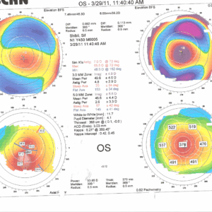 Orbscan של קראטוקונוס