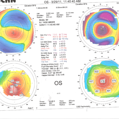 Orbscan של קראטוקונוס