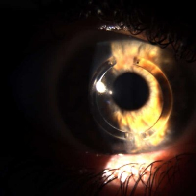 עין בה מושתלות טבעות Intacs SK